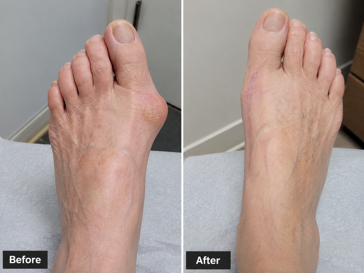 Bunion Correction — Significant Deformity — before and after treatment by Mid-South foot and ankle podiatry surgeon