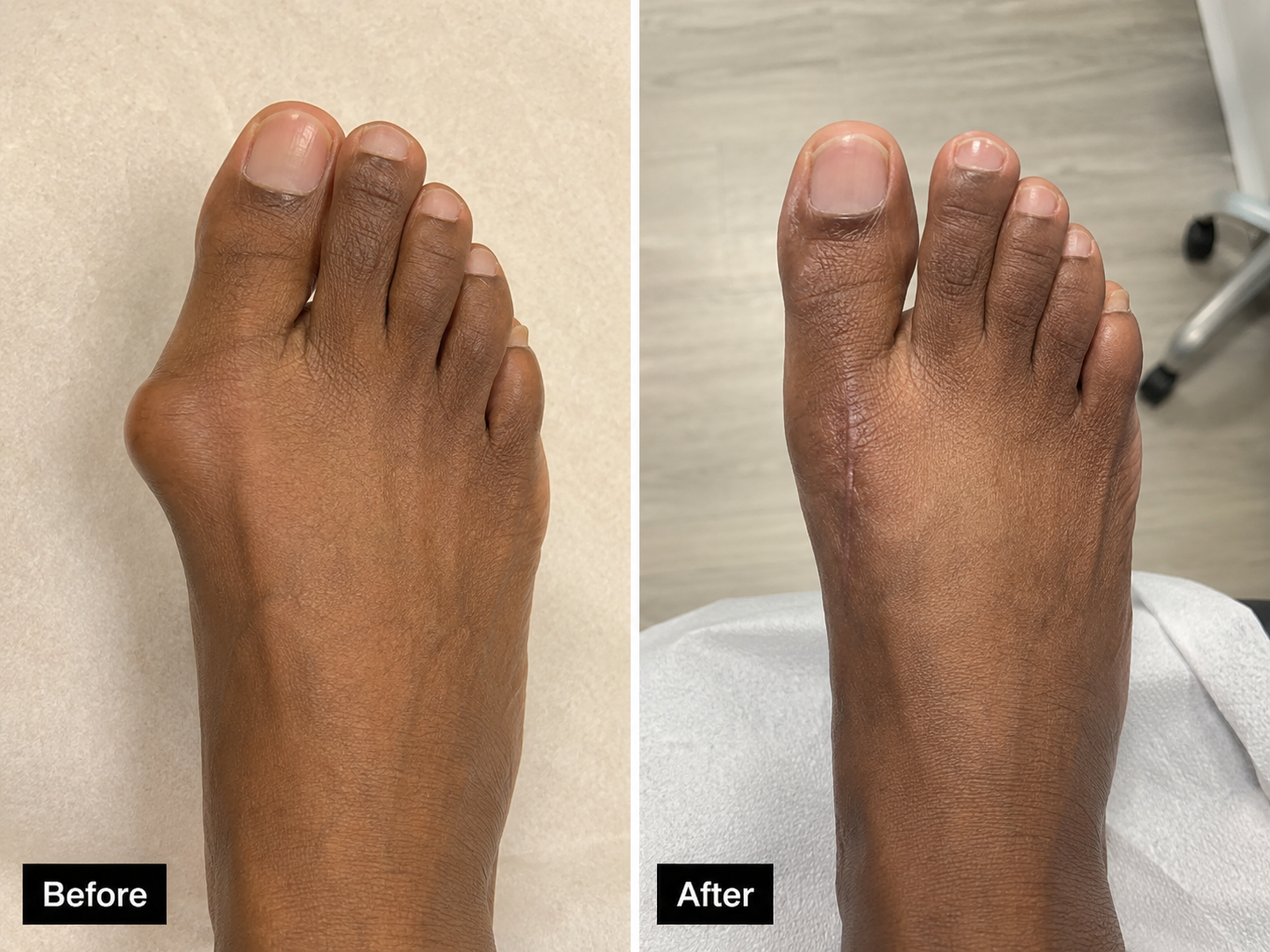 Bunion Correction — Mild Deformity — before and after treatment by Mid-South foot and ankle podiatry surgeon