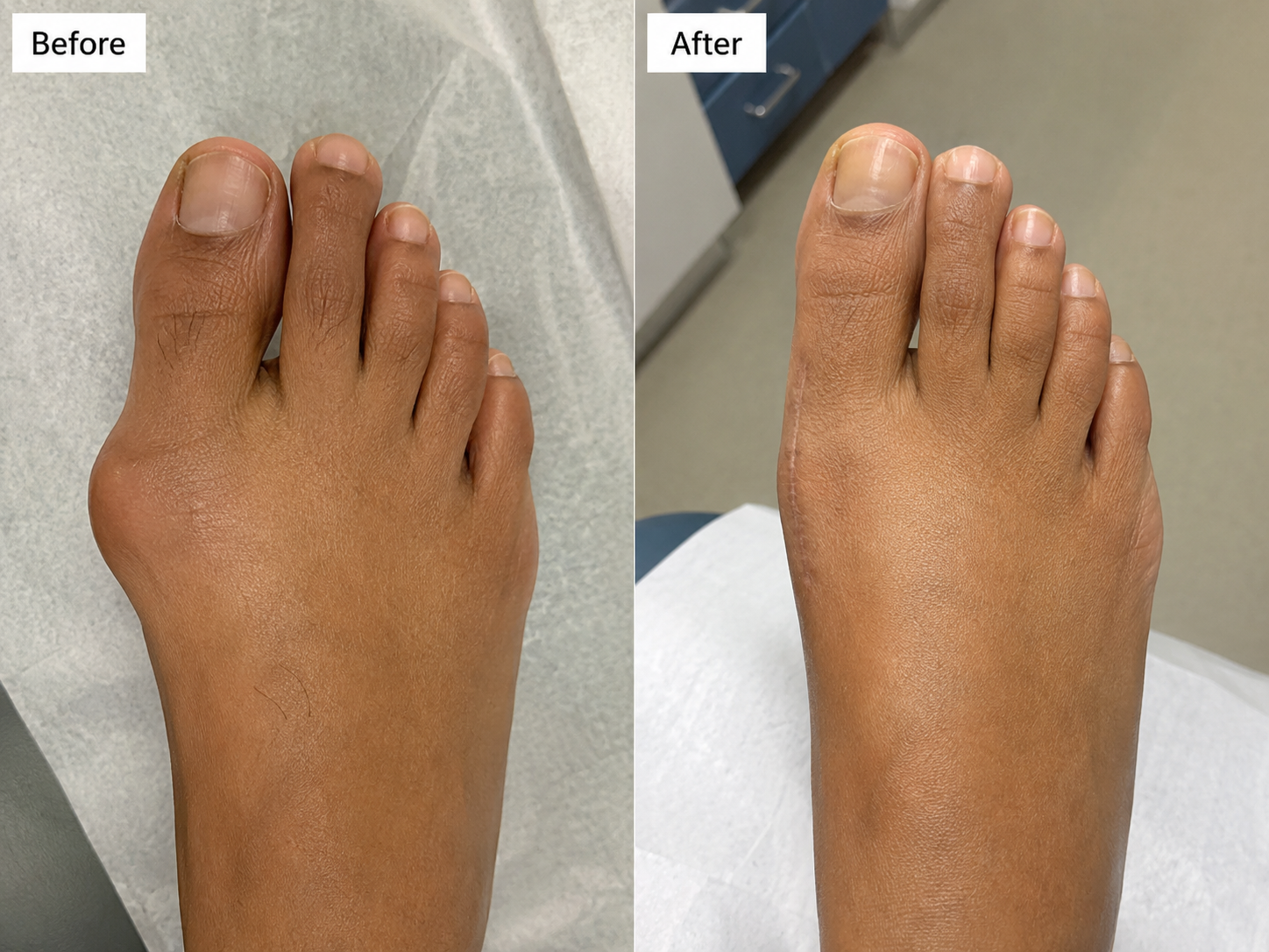 Bunion Correction — Moderate Deformity — before and after treatment by Mid-South foot and ankle podiatry surgeon